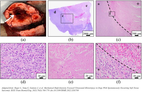 Figure 4. Representative images demonstrating histotripsy ablation of STS. (a) Gross visualization of lesion characterized by extensive tissue necrosis and hemorrhage (arrow). (b-f) H&E stained sections compared (d) untreated (magnification 40x) and (e) treated (magnification 40x) tumor tissues and (b,c,f) interface regions (c – magnification 2x; f – magnification 40x). clearly delineated boundaries between treated (+) and untreated (*) tumor tissue were observed.