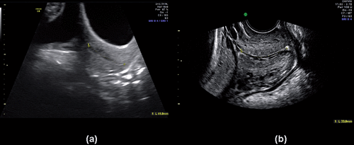 Figure 1.  (a) Transabdominal and (b) transvaginal ultrasound cervical length measurement.