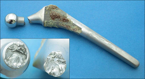 Figure 1. Macrophotograph of fractured stem. Insert shows surface of fracture.
