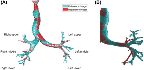 Figure 1. (A) Airway segmentation for a reference image (blue) with overlay of a registered image (red). Three superior-inferior positions for the bronchial bifurcations were defined as: upper, middle and lower lung positions. The bronchial branch point in the upper right and left lung segment were classified to the upper position. The right middle lung- and the ligulae segment in the left lung were classified as middle position and the right and left lower lung segment were classified to the lower position. (B) Bronchial segment following image registration where local deformations result in misaligned airway segment.