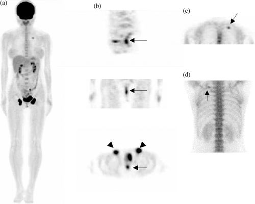 Figure 2.  Whole-body PET was performed 45 min after an intravenous injection of 300 MBq FDG using a Siemens ACCEL PET scanner. Additional 3-h-delayed images after emptying the urinary bladder were also obtained. (A) Maximal intensity projection (MIP) imaging revealing focal increases in FDG uptake in the bilateral inguinal regions and in the posterior aspect of the left upper thorax. The rectal region was obscured by the full urinary bladder. (B) Delayed image in the sagittal and coronal sections revealing focal increase activity in the rectum (upper and middle), and a transverse section revealing FDG uptake in the rectum and bilateral inguinal lymph nodes (lower). The maximal standard uptake value (SUVm) of the rectal lesion was 5.9. (C) Coronal section of the thorax revealing a focal area with increase FDG uptake. A corresponding finding was observed in the posterior view of the Tc-99m MDP bone scan which showed a solitary hot spot in the left 4th rib (D).