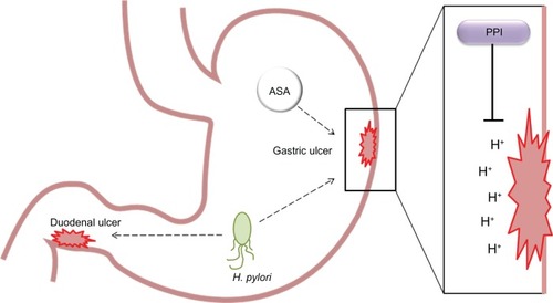 Figure 2 Model of peptic ulcer formation. In the stomach, both Helicobacter pylori and aspirin are able to induce gastric ulcer formation. Proton pump inhibitors act to reduce gastric acid production, thereby reducing ulceration in the stomach lining.
