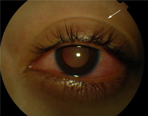 Figure 1 Color photograph of a patient in the chronic recurrent phase of the VKHD showing acute anterior uveitis and mild poliosis (white arrow).