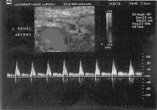 Figure 3. Transverse color Doppler US image. The peak systolic velocity is below 100cm/sec, which is considered normal.