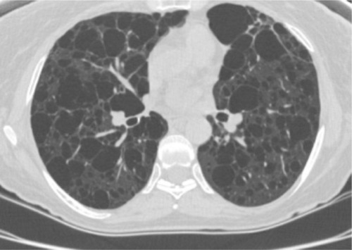 Figure 4 Chest computed tomography scan showing parenchymal destruction associated with lymphangioleiomyomatosis in a patient with tuberous sclerosis complex.