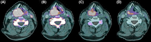 Figure 2. 18F-FLT PET-CT scans of a patient with a cT4N2M0 hypopharyngeal tumor before therapy (A), after induction cetuximab (B), after 1 week of radiotherapy (two doses of cetuximab, 10 Gy) (C) and after 3 weeks of radiotherapy (four doses of cetuximab, 32 Gy) (D). Note the concurrent reduction in cervical vertebra marrow proliferation after start of radiotherapy.