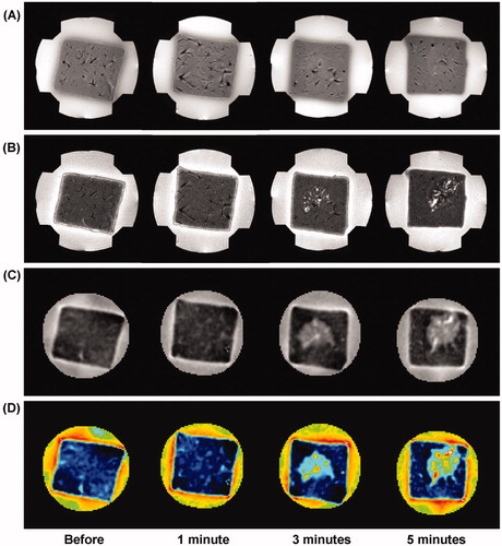 Figure 4. Time-course variation of liver tissue before and after RF ablation at 50 W. (A) T1-weighted, (B) T2-weighted, (C) reconstructed conductivity, and (D) colour-coded conductivity images obtained before and after 1, 3, and 5 min ablation time, respectively. Reconstructed conductivity images show significantly increased contrast and well-defined lesions for more than 3 min of exposure time.