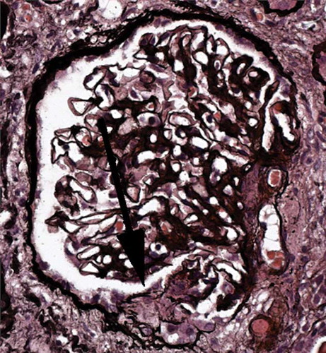 Figure 2. Renal biopsy. Glomerulus showing an acute segmental lesion (arrowed) with a well-demarcated collection of cells in Bowman’s space, overlying a capillary loop with thrombosis and disruption of the basement membrane, characteristic of an acute necrotizing crescentic glomerulonephritis with an index of chronicity of 20%. The immunoperoxidase study showed no significant deposition of immunoproteins in the glomeruli.
