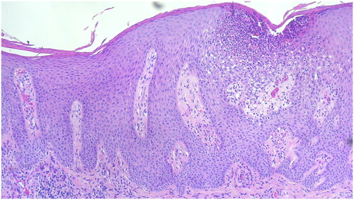 Figure 3. Histology of a skin biopsy from the lesion on the elbow with hyper- and parakeratosis, acanthosis, papillomatosis and subcorneal Munro’s microabscess, that is typical for psoriasis. Hematoxylin-eosin staining, ×100.