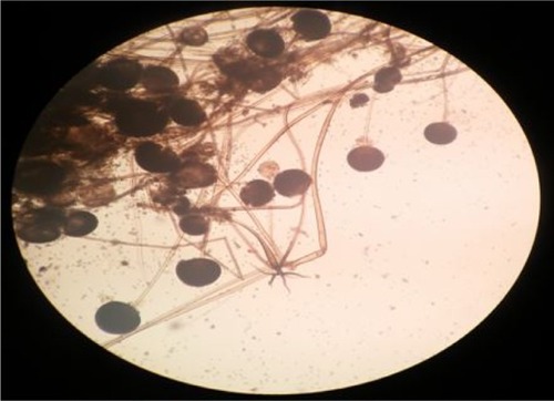 Figure 7 Filamentous branching aseptate hyphae with sporangia.Note: Magnification: 40×.