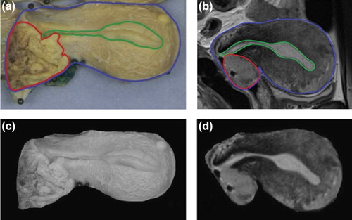 Figure 1. An example of a 2D digital photo of the macroscopic intersection (a) and the corresponding 2D sagittal MR image (b) with delineated structures [cervix-uterus (blue), uterine cavity (green), GTV (red)]. The cervix-uterus structures were segmented from the background on the photo (c) and from surrounding tissue on MRI (d).