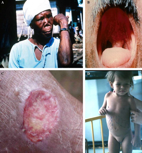 Figure 2 Some of clinical patterns of leishmaniasis. (A) Primary healed lesion and secondary destructive lesion of mucocutaneous leishmaniasis (L. panamensis). (B) Oropharyngeal lesion (L. braziliensis). (C) Cutaneous leishmaniasis with a large ulcerative lesion on the arm (L. panamensis). (D) Hepatosplenomegaly of visceral leishmaniasis (L. infantum). (Photographies from Laboratory of Parasitology-Nantes and PECET-Colombia).