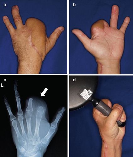 Figure 4. (a, b) Photographs and radiograph at 18 months postoperatively. The skin paddle of the flap was set to divide and cover the two stumps and dorsum of the hand. Almost all pain had disappeared at 18 months postoperatively. (c) Postoperative radiograph shows good alignment of the two stumps (arrow). (d) Range of motion, including that of the other fingers, substantially recovered. The patient can now grasp things easily without pain and enjoys motorbike riding.