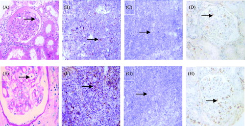 Figure 1. Example of the glomerulitis and immunostaining for two markers (×400, DAB stain × 400): (A) glomerulitis with HE stain (arrow); (B) CD3-positive controls; (C) CD3-negative controls; (D) CD3-positive T lymphocytes in the glomerulus (arrow); (E) glomerulitis with PAS stain (arrow); (F) CD68-positive controls. (G) CD68-negative controls; (H) CD68-positive T lymphocytes in the glomerulus (arrow).