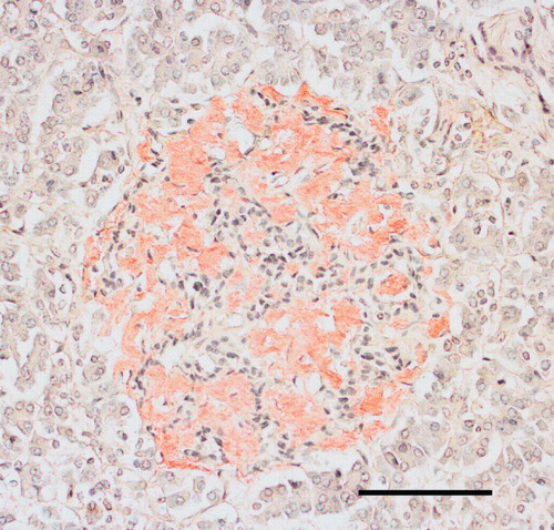Figure 4. Human islet from a diabetic subject. Most of the islet has been converted into amyloid, but there are still cords of cells, a majority being β-cells, most probably dysfunctional. Congo red. Bar: 50 μm.
