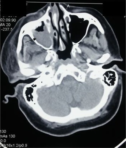 Figure 5 Computed tomography of paranasal sinuses showing right maxillary sinusitis with spread of inflammation to infratemporal fossa.