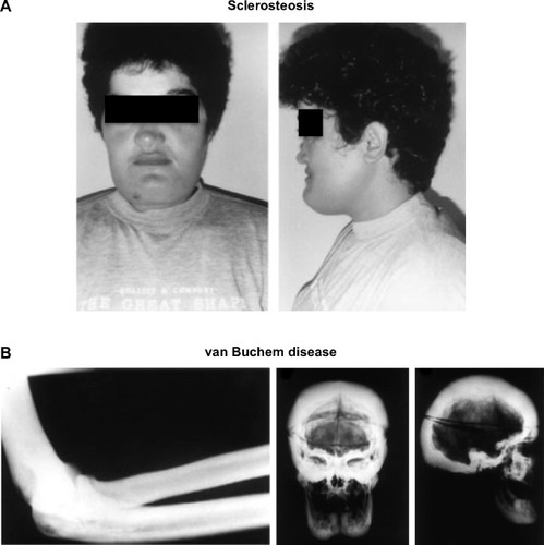 Figure 2 Clinical effects of sclerosteosis and van Buchem disease.