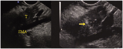 Figure 6. Cryoablation. Hyperechoic line along the path of the probe surrounded by nonhomogeneous tissue with hyperechoic spots. T, tumour; SMA, superior mesenteric artery. Reprinted from [Citation103] Copyright 2018, with the permission of Elsevier.