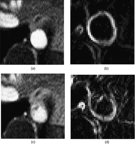 Figure 9. Two different time points of the supra-celiac aorta acquired using PCMRI. During peak systole (a), the supra-celiac aorta is approximately 20 pixels across and the lumen boundary is clearly visible in the zoomed view of the magnitude of the gradient plot (b). However, during parts of diastole, the lumen boundary is not as clearly defined, as seen in (c) and the corresponding zoomed magnitude of the gradient plot (d).