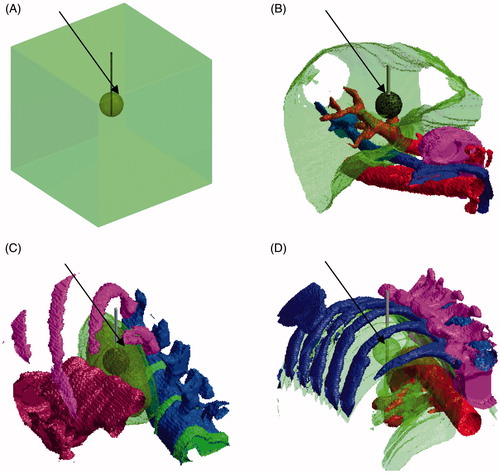 Figure 1. Human models with a spherical tumour embedded (indicated by the arrows) within them: (A) a simplistic model of two compartments, and three realistic anatomy models for (B) liver, (C) kidney, and (D) lungs. The active part of the electrode was placed into the tumour.