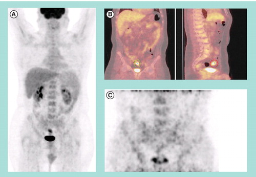 Figure 1. (A) Preoperative 18F-fluorodeoxyglucose (FDG) PET/CT maximum intensity projection and (B) cross sectional fused 18F-FDG PET/CT images of a colorectal cancer patient demonstrating a solitary hypermetabolic focus in the sigmoid colon. (C) Postoperative 18F-FDG PET/CT maximum intensity projection of the lower abdomen and pelvis demonstrates no evidence of hypermetabolism in the region of the previously resected sigmoid mass.