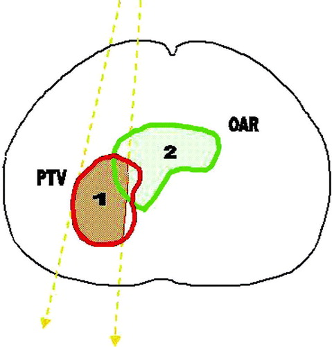 Figure 1.  The optimization geometry. The beam edges are shown as dashed thick lines. The aim is to maximize the shaded area of: (1) the portion of PTV irradiated , and (2) the portion of OARs spared .