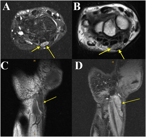 Figure 2. 2 A. T2 axial, 1B. T1 axial, 1 C. T1 coronal, and 1D. T2 coronal magnetic resonance imaging of the left wrist demonstrating abnormal enlargement with mixed signal involving the median nerve just proximal to the carpal tunnel (yellow arrow). Note the coaxial cable-like appearance on the coronal imaging and honeycombing on the axial consistent with fibrolipomatous hamartoma.
