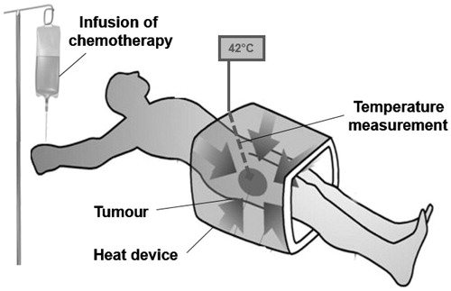 Figure 1. Regional hyperthermia as targeted therapy. Schematic illustration of regional hyperthermia (39–43 °C) targeting the heating field to the area of an intra-abdominal, deep-seated malignant tumour. The external heating device is represented by an open applicator surrounding the body axis of the patient. The increased understanding to control energy deposition in vivo has led to the design of commercially available multi-antenna applicators and the implementation of systems for monitoring temperature distribution within the heated tumour and the tumour-associated stroma.