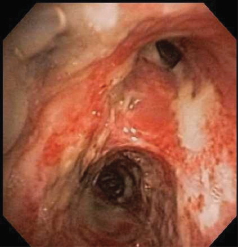 Figure 2. Image on bronchoscopy of the right main bronchus in a patient with chronic obstructive pulmonary disorder with acute pneumonia. The lower airway mucosa is denuded with mucopurulent secretion that later cultured Staphylococcus aureus.