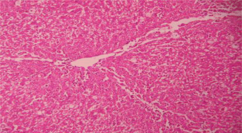 Figure 9.  Liver section of PdEE (200 mg/kg) and CCl4 shows fatty changes necrosis, ballooning degeneration and few infiltrations of lymphocytes.