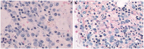 Figure 1. Pathological changes of marrow biopsy. (A) The initial marrow biopsy (2010), (B) the repeated marrow biopsy (2012). The initial marrow biopsy showed active myelosis and 26% plasmocytes. The myeloma cells were distributed in clusters (Figure 1A). Second time marrow biopsy showed plasmacytes spreading around, but no plasmacytes in clusters (Figure 1B).
