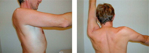 Figure 2. Shoulder arthrodesis. Postoperative flexion and abduction.