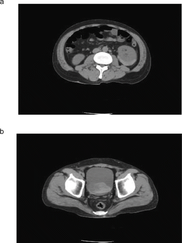 Figure 1.  CT scan shows a large perinephric, intracapsular hematoma of left kidney.