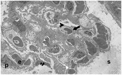 Figure 19. (Electron micrographs show ischemia/reperfusion + aliskiren 50 mg/kg group ultrastructure). Electron micrographs showing a glomerular capillary with normal basal lamina (arrow head). Capillary basement membrane lamina densa, lamina rara interna and externa clear appear (arrow). Electron microscopic findings show typical podocytes (p) and foot process (arrow). Erythrocyte (e). Bowman’s capsular space (s). 15,000×.