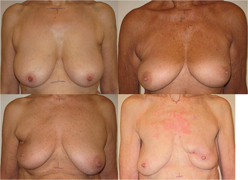 Figure 4. Example of the different grades of cosmetic outcome on patients from the cohort. Cosmetic outcome; top left: Excellent, top right: Good, bottom left: Fair, bottom right: Poor.