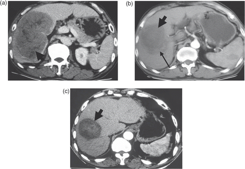 Figure 4. Transverse contrast-enhanced CT scans in patient 3. (a) Pre-ablation scan showed a 13.8 × 9.2-cm cancer nodule (indicated by the wide arrow). (b) Scan obtained two weeks after the first session of ablation showed an incomplete ablation (residual area indicated by the narrow arrow) with a 10 × 6.5-cm coagulation zone (indicated by the wide arrow). (c) Scan obtained two weeks after the second session of ablation showed a complete ablation (except the PVTT lesion) with a 7.3 × 6.1 cm coagulation zone (indicated by the wide arrow).