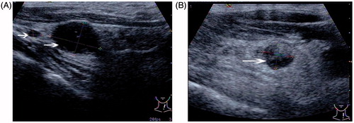 Figure 2. A 62-year-old woman with previous thyroidectomy for papillary carcinoma developed two recurrent lymph nodules in the left neck, level IV. The patient refused surgery. (A) Transverse greyscale ultrasound imaging prior to ablation revealed two rounded hypoechoic recurrent masses (measured volume = 0.10 mL, 1.17 mL, arrow) in the left neck, level IV. (B) A follow-up ultrasonogram 1 month after the ablation shows that the larger one has decreased in volume (0.37 mL, arrow), and we cannot find any evidence of the smaller one at the previous site.