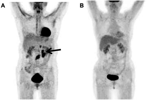 Figure 7 A patient with end-of therapy 18F-FDG PET/CT showed increased 18F-FDG uptake in the abdomen (arrows). D-5PS and IHP criteria were considered positive for patient, and the patient experienced relapse after 7 months of follow-up (A). A patient with an end-of therapy 18F-FDG PET/CT D-5PS (score 1) and negative IHP criteria did not show progression and survived at the end of the 71-month follow-up period (B).