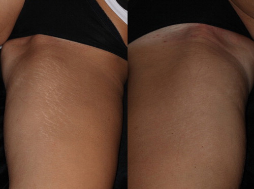 Figure 5. A 22 year-old ST IIIb female who presented with widespread striae alba after weight loss. The image on the left was taken before treatment and the image on the right was taken after 3 treatment sessions, as described in the section, Materials and Methods. Marked improvements in the texture as well as the color of the striae (from IIIb to IIa, according to the Deprez-Adatto scale) can be seen following the treatment, as compared to the baseline.