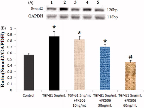 Figure 2. FK506 reduced the expressions of Smad2 protein increased by TGF-β1 in mesangial cells. Notes: Mesangial cells were cultured and treated with TGF-β1 5 ng/mL with or without the addition of FK506 (10, 30, and 60 ng/mL) for 48 h. Total cell protein lysates were prepared and subjected to Western blotting analysis with antibody against Smad2 and GAPDH. Experiments were repeated thrice with similar results. *p < 0.05 as compared with control group; #p < 0.05 as compared with TGF-β1 stimulated group. Lane 1: control; Lane 2: TGF-β1 5 ng/mL treatment; Lane 3: TGF-β1 5 ng/mL + FK506 10 ng/mL treatment; Lane 4: TGF-β1 5 ng/mL + FK506 30 ng/mL treatment; Lane 5: TGF-β1 5 ng/mL + FK506 60 ng/mL treatment.