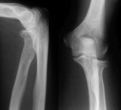 Figure 2. Initial presentation AP and lateral radiographs of a 27-year-old male who sustained a Mason type-I fracture of the left elbow while playing sport. An Essex-Lopresti lesion was diagnosed at 2 weeks when bilateral wrist radiographs were taken. Management was conservative, using collar and cuff immobilization for 1 week followed by supervised physiotherapy. At 6 months, the patient had a flexion arc of 152 degrees and a forearm rotation arc of 180 degrees, with an excellent MES (100).