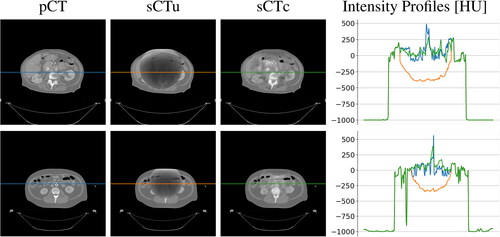 Figure 5. Examples of two CT axial slices with their corresponding sCT generated overriding the uncorrected simulated CBCT (sCTu) and the corrected ones (sCTc). The intensity profiles of the central row (marked as a line in both images) are plotted in the right panel. Each image is displayed with Window = 1300, Level = 0.