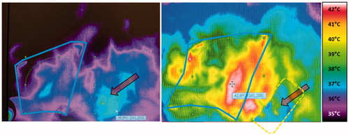 Figure 6. Thermographic control at the onset and during wIRA-hyperthermia. A pigmented senile wart (arrow) was detected early after starting the therapy because of its relatively high absorbance due to chromophores resulting in rapid temperature elevation. In order to avoid its influence on the power steering, the wart was protected with tape, so that heating of the region of interest was no more disturbed. Treated region with field marks is indicated by the solid line; broken rectangle depicts the area protected with tape.