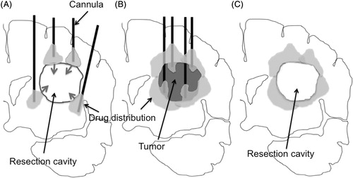 Figure 4. Schema of the current problem for post surgical peri-tumoral CED (A). After tumor resection, the brain surrounding the tumor is adjacent to a lower pressure space, i.e. resection cavity. Once the infusate leaks into the resection cavity during CED, the distribution into surrounding brain ceases. Schema of proposed pre-surgical CED (B). As demonstrated in Figure 2, peri-tumoral CED prior to tumor removal can distribute infusate robustly into brain surrounding the tumor at the tumor-brain interface. Infusion from multiple cannulae inserted into the peri-tumoral area enables robust drug distribution at the tumor-brain interface. Removal of the tumor afterward may be ideal (C). Brain tissue surrounding resection cavity contains distributed drug after surgical resection.