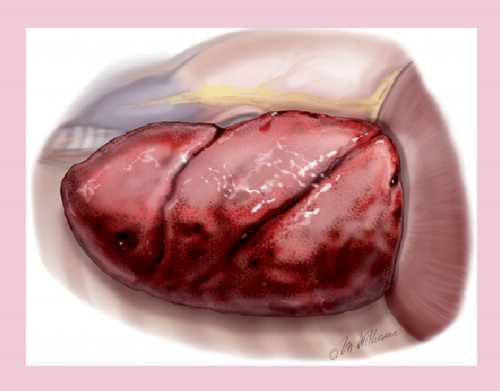 Figure 6. Pleurectomy/decortication: appearance of the decorticated lung after the visceral and parietal pleurae have been resected (with diaphragm intact).To achieve macroscopic complete resection for a tumor that invades the diaphragm, a split-thickness, partial or complete hemi-diaphragmatic resection may be required. In the case of partial resection, primary repair or autologous reconstruction may be possible, but in the case of complete resection, a patch is created similar to the technique of extrapleural pneumonectomy, which has previously been described Citation[17].