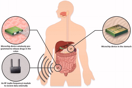 Figure 7. An orally administered drug delivery microchip using wireless transmission of power and data can be activated at a specific time or at a specific location in the gastrointestinal tract (Sheppard et al., Citation2007).