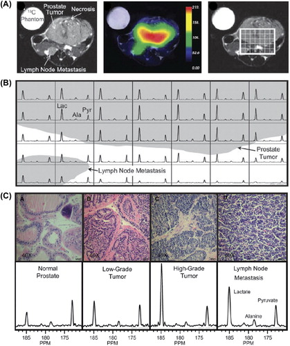 Figure 3. Hyperpolarized 13C metabolic images of a TRAMP mouse. Upper: Hyperpolarized 13C lactate image following the injection of hyperpolarized [1-13C]pyruvate, overlaid on T2-weighted 1H image. Middle: Hyperpolarized 13C spectra of primary and metastatic tumor regions. Lower: Representative H&E-stained sections and hyperpolarized 13C spectra for one case from each of the histologically defined groups. The 3D MRSI shows substantially elevated lactate in the high-grade primary tumor compared with the low-grade tumor. Ala, alanine; Lac, lactate; Pyr, pyruvate (see [Citation22]).