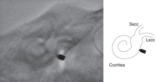Figure 7. X-P finding of floating mass transducer (FMT) placement after VSB surgery. Good placement of the FMT with the round window (RW)-Coupler was confirmed. Scheme of X-P is shown. Lscc, lateral semicircular canal; Sscc, superior semicircular canal.