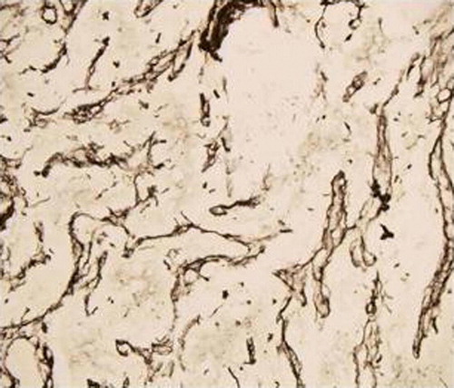 Figure 3.  Photomicrograph of patient 3 showing reticulin positivity in stroma on immunohistochemistry (H&E×100)