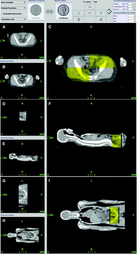 Figure 1.  MVCT scan taken at the abdomen before treatment delivery. MVCT scan set was fused with treatment planning CT scan. The transverse sectional views are shown in (A) Tomo MVCT image and in (B) reference kVCT image. The fusion column (C) presents the kVCT in gray scale with the MVCT superimposed with a level of transparency in yellow. Similarly, the sagital sectional views and the coronal sectional views are shown in D, E, F and G, H, I respectively.